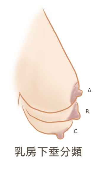 乳房下垂分類(lèi).jpg