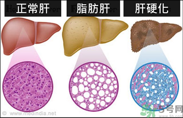 得了脂肪肝該怎么治？脂肪肝對(duì)人體危害有多大？