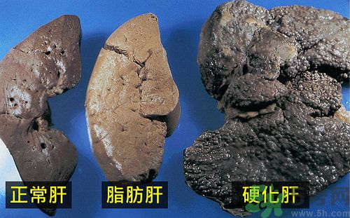得了脂肪肝該怎么治？脂肪肝對(duì)人體危害有多大？