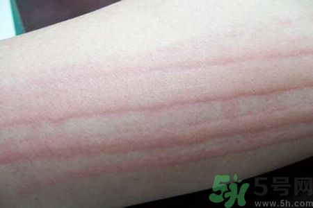 蕁麻疹會不會傳染？蕁麻疹怎么治才能好？