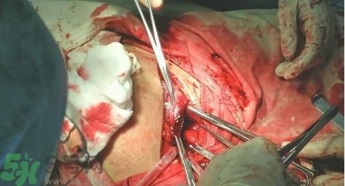 剖腹產傷口多久愈合?剖腹產傷口怎么恢復的快