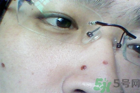 激光點痣后可以洗臉嗎？激光點痣后需要注意什么？