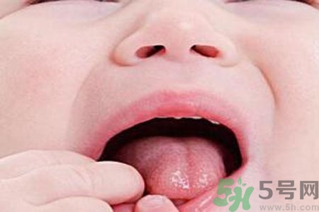 寶寶口腔潰瘍怎么辦？治療寶寶口腔潰瘍方法有什么？
