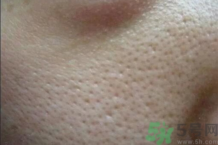 皮膚毛孔粗大原因有哪些？如何預防皮膚毛孔粗大？