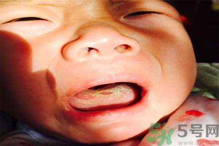 舌頭燙傷后該怎么辦呢？舌頭燙傷后應該注意吃什么？?
