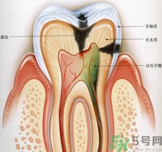 什么是根管治療？為什么牙齒疼要做根管治療？