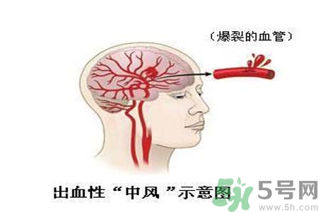 腦中風(fēng)的護(hù)理措施？腦中風(fēng)的飲食護(hù)理？