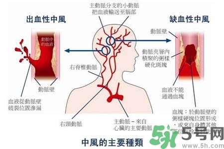 腦中風的發(fā)病因素？腦中風的并發(fā)癥有哪些 ？