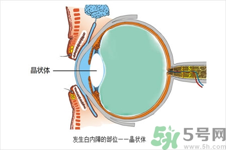 白內障的護理措施是什么？白內障的飲食護理有哪些？