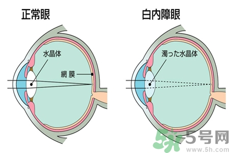白內障治療方法是什么？白內障可以用什么藥物治療？