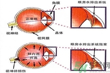 青光眼的發病因素是什么？青光眼的并發癥有哪些？