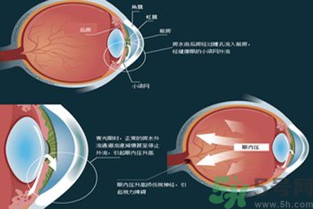 青光眼的高發(fā)人群有哪些？如何預(yù)防青光眼？