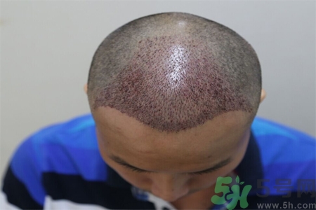 脫發的原因是什么？脫發會引發什么疾病？