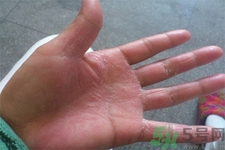 手足癬的易發(fā)人群有哪些？如何預防手足癬？