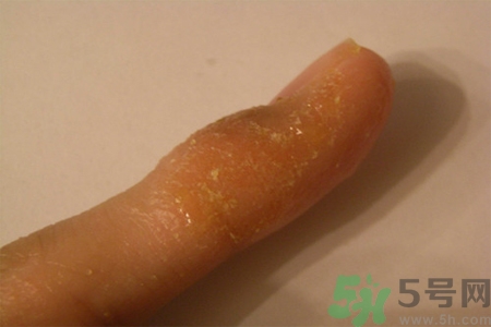 手足癬的易發(fā)人群有哪些？如何預防手足癬？