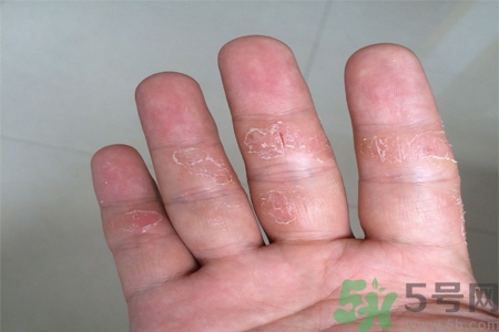 手足癬的易發(fā)人群有哪些？如何預防手足癬？