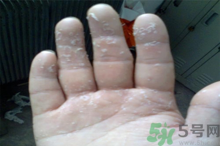 手足癬的易發(fā)人群有哪些？如何預防手足癬？