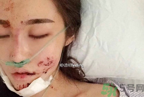 知名網紅被毀容是誰?車禍毀容的賠償標準