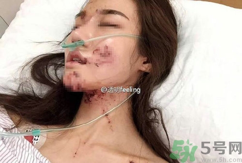 知名網紅被毀容是誰?車禍毀容的賠償標準