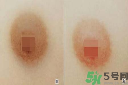 乳頭發(fā)黑怎么辦？怎么樣可以使乳頭變白？