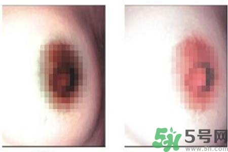 乳頭發(fā)黑怎么辦？怎么樣可以使乳頭變白？