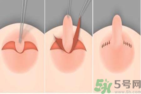 乳頭內(nèi)陷怎么回事？乳頭內(nèi)陷的原因是什么？