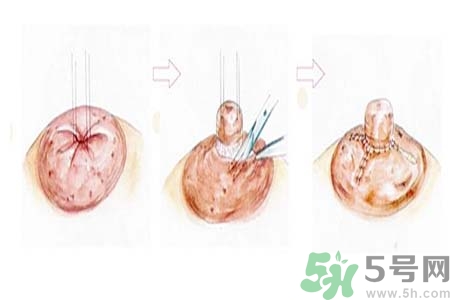 乳頭內(nèi)陷怎么回事？乳頭內(nèi)陷的原因是什么？