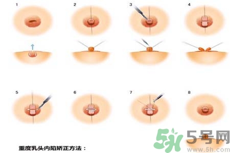 乳頭內(nèi)陷怎么回事？乳頭內(nèi)陷的原因是什么？