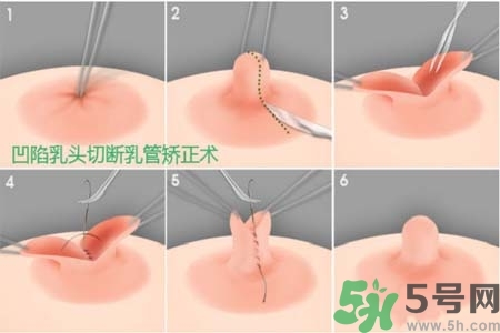 乳頭內(nèi)陷怎么辦？乳頭內(nèi)陷的癥狀有哪些？