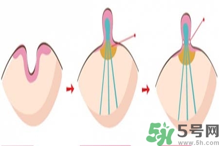 乳頭內(nèi)陷怎么辦？乳頭內(nèi)陷的癥狀有哪些？
