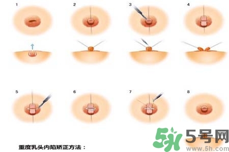 乳頭內(nèi)陷怎么辦？乳頭內(nèi)陷的癥狀有哪些？