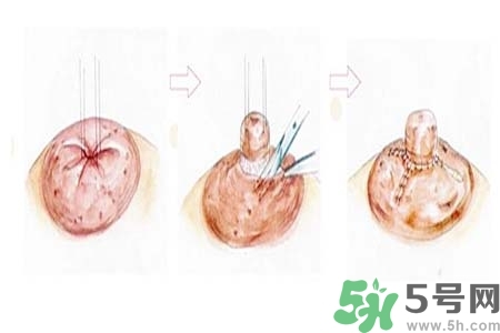乳頭內(nèi)陷怎么辦？乳頭內(nèi)陷的癥狀有哪些？