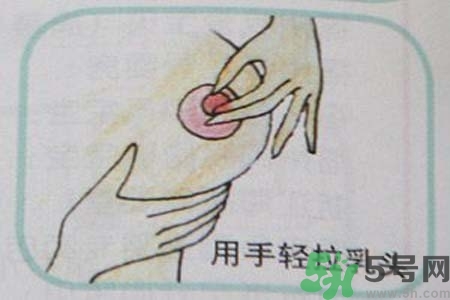 乳頭內(nèi)陷怎么辦？乳頭內(nèi)陷的癥狀有哪些？