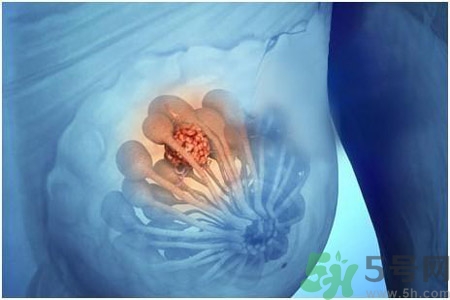 乳房屋硬塊有疼痛感怎么回事？乳房屋硬塊有疼痛感怎么辦？