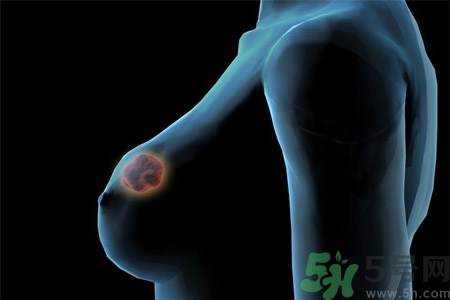 怎樣區分乳房包塊是良性還是惡性？如何診斷乳房腫塊是惡性還是良性？