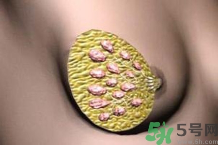 乳腺增生鈣化是什么？乳腺鈣化的癥狀有哪些？