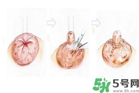乳頭內(nèi)陷怎么矯正？乳頭內(nèi)陷矯正方法是什么？