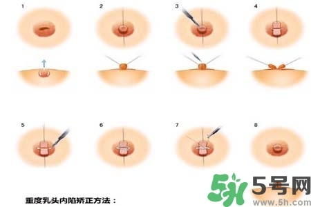 乳頭內(nèi)陷怎么矯正？乳頭內(nèi)陷矯正方法是什么？