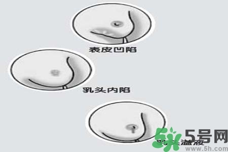 乳頭內(nèi)陷怎么矯正？乳頭內(nèi)陷矯正方法是什么？