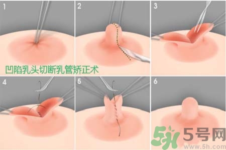 乳頭內(nèi)陷怎么矯正？乳頭內(nèi)陷矯正方法是什么？