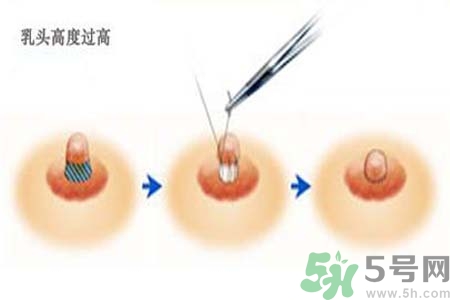 乳頭內(nèi)陷能不能喂奶？乳頭凹陷怎樣哺乳？