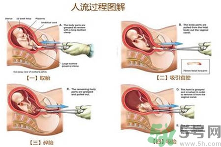 人工流產(chǎn)后多久可以再次懷孕？流產(chǎn)后需要注意什么？