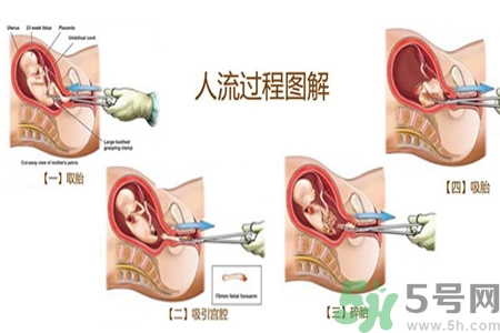 人工流產(chǎn)后多久可以再次懷孕？流產(chǎn)后需要注意什么？