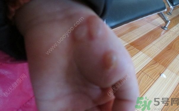 15歲還會得手足口病嗎？手足口病的癥狀有哪些？