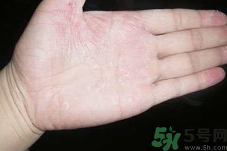?手掌脫皮的危害有哪些？如何預防手掌脫皮？