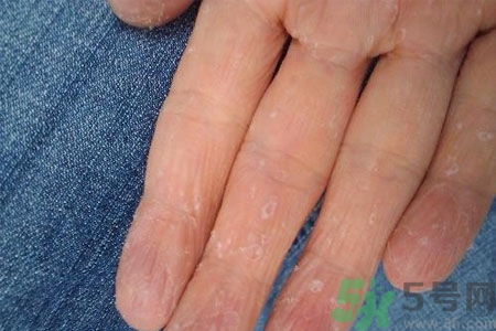 ?手掌脫皮的危害有哪些？如何預防手掌脫皮？