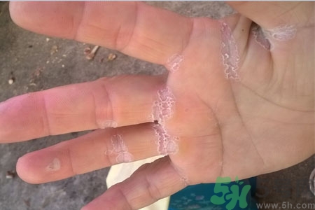 ?手掌脫皮的危害有哪些？如何預防手掌脫皮？