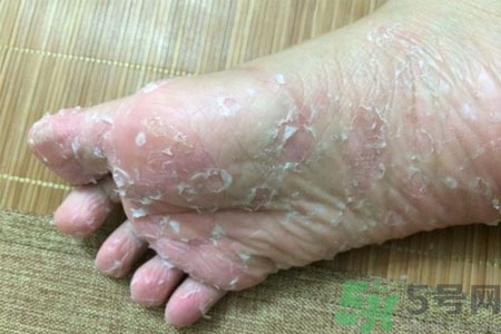 腳脫皮是怎么回事？腳脫皮怎么辦？