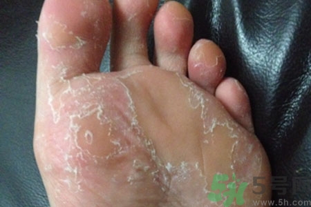 腳脫皮是怎么回事？腳脫皮怎么辦？