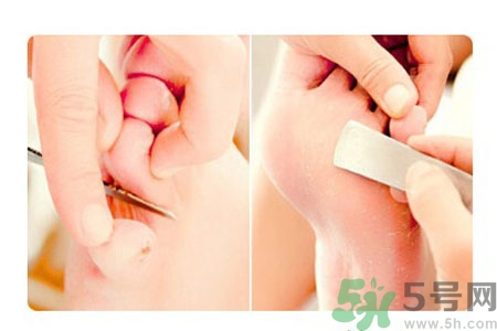 雞眼怎么能徹底根治？如何預(yù)防腳上長雞眼？